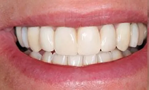 A strong, natural smile with renewed confidence and comfort.