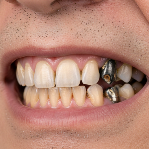 Missing teeth, loose dentures, reduced confidence.