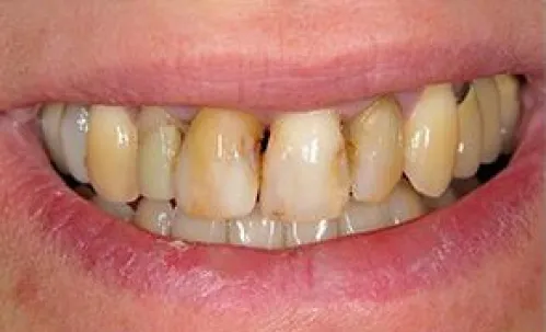 Missing teeth, loose dentures, reduced confidence.